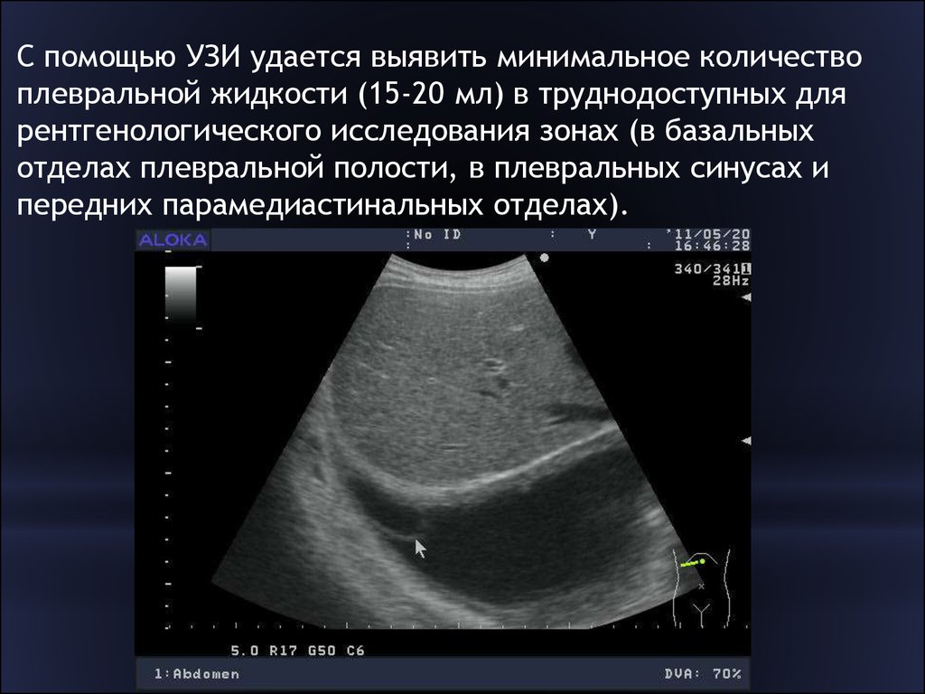 Таблетки быстро снижающие давление под язык капотен