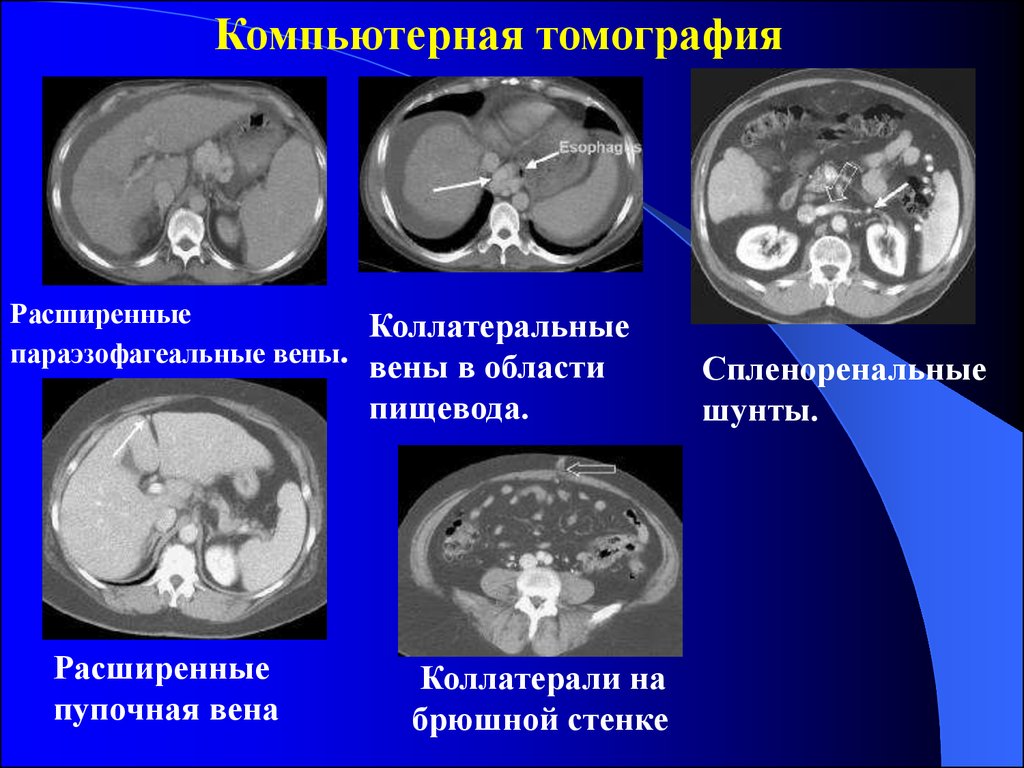 Варикоз Брюшной Полости Причины Симптомы Диагностика Лечение