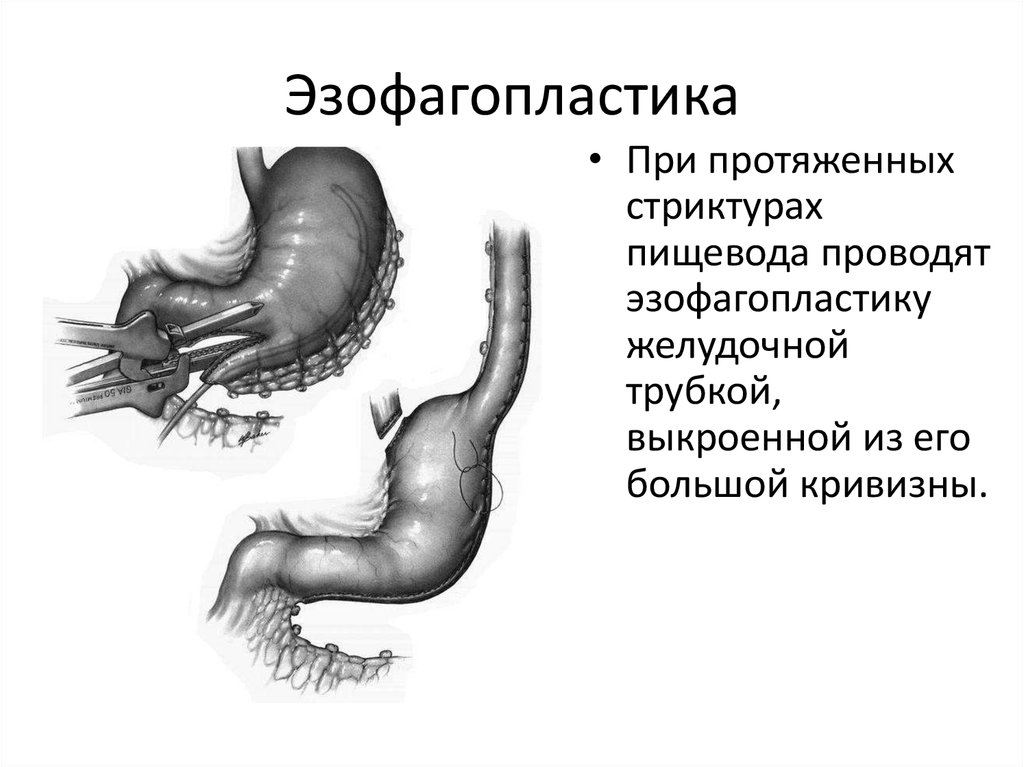 Диета При Стенозе Пищевода