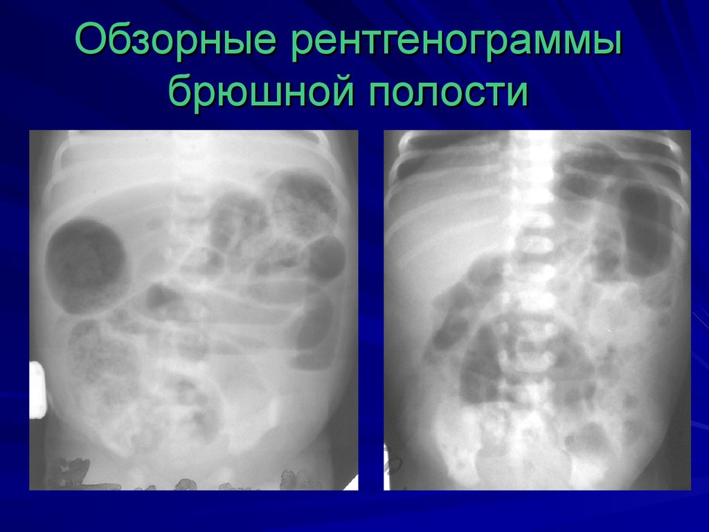 Обзорные рентгенограммы брюшной полости