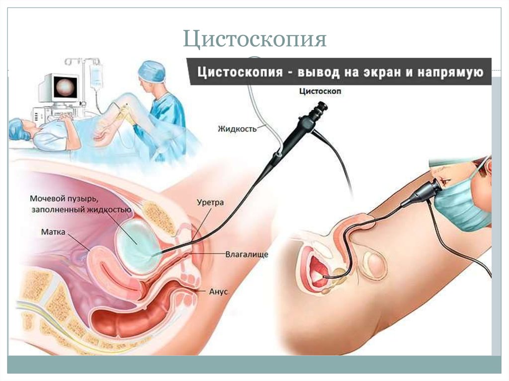 Можно Ли Заниматься Сексом После Цистоскопии