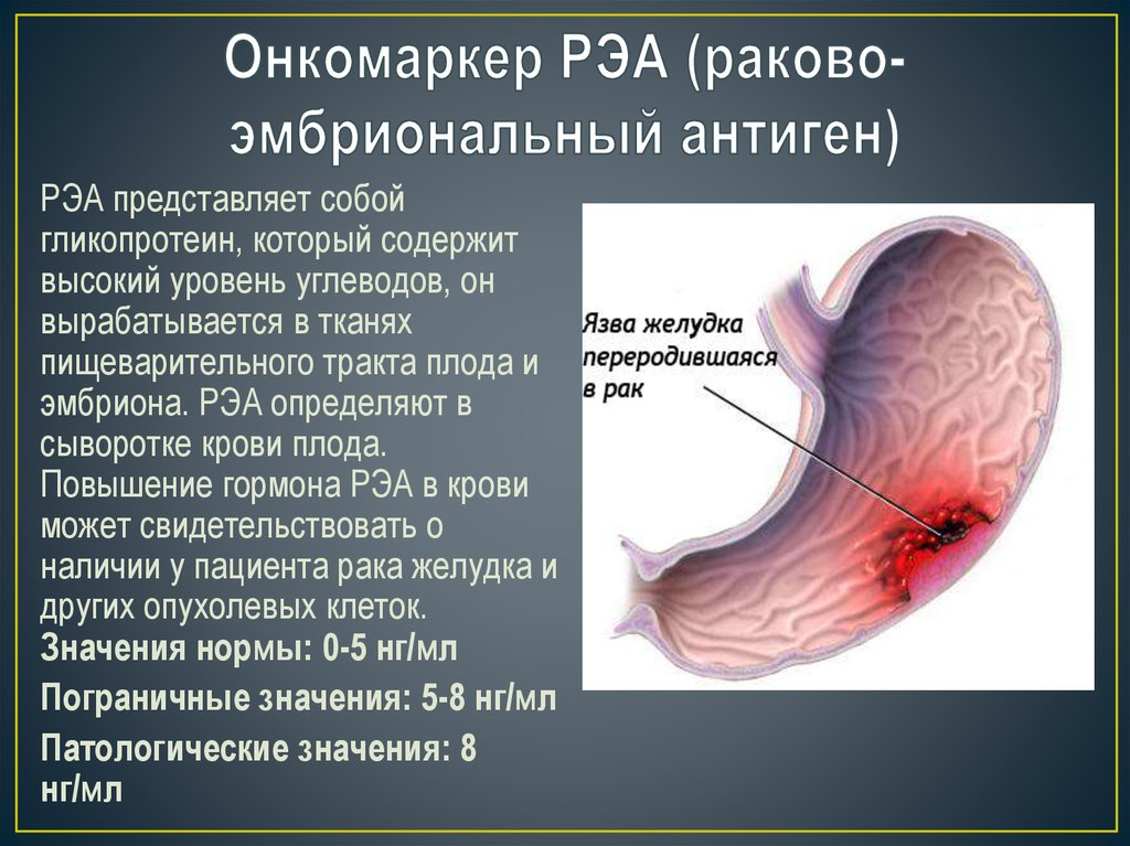 Раковый эмбриональный антиген (РЭА)