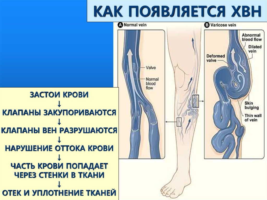 Варикоз 3 Стадия Сколько Живут