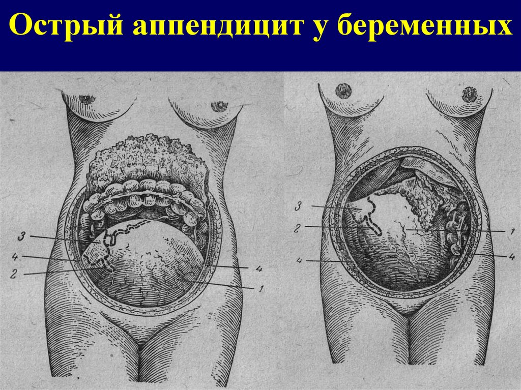 Крутит ноги у беременных 59