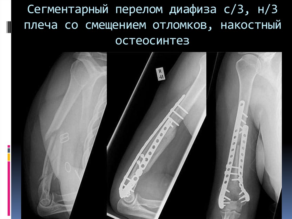 Переломы плечевой кости презентация