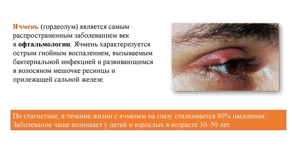 Амблиопия программа паучок