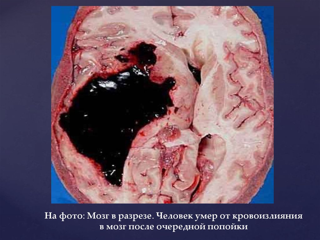 Кровоизлияние в мозг у беременных 38