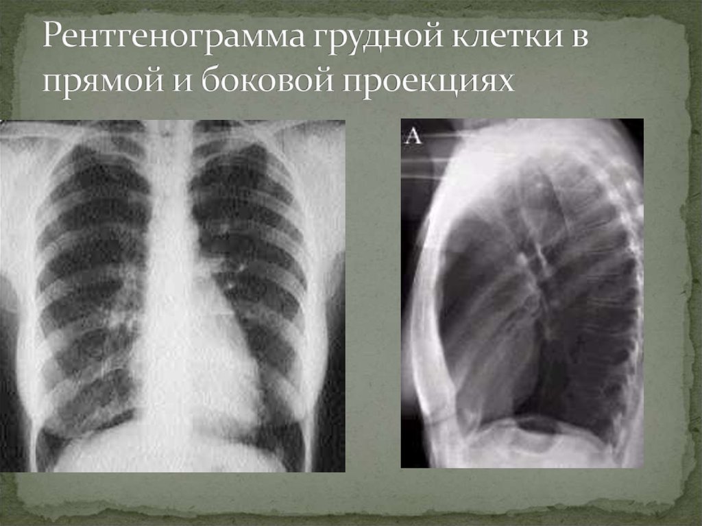 Рентгенограмма грудной клетки в прямой и боковой проекциях