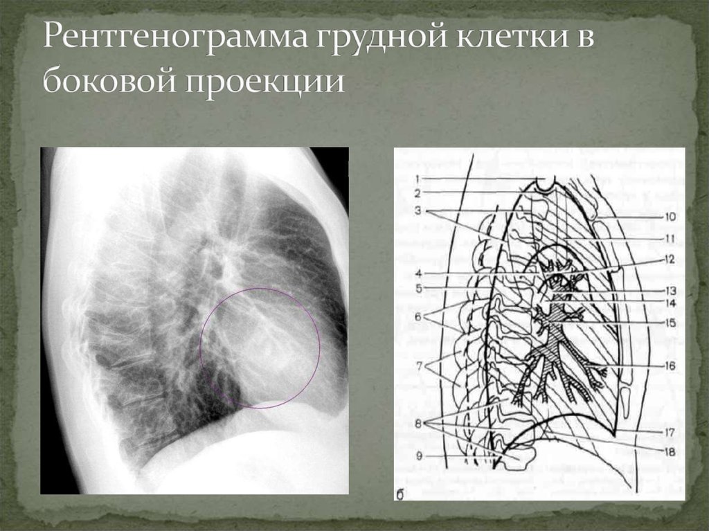 Рентгенограмма грудной клетки в боковой проекции