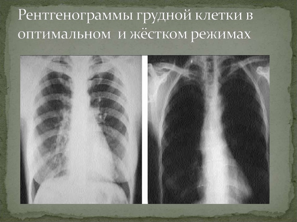Рентгенограммы грудной клетки в оптимальном и жёстком режимах