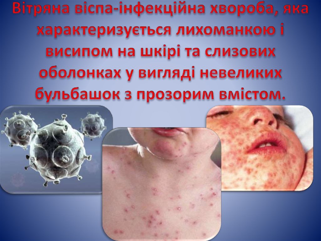 Вітряна віспа-інфекційна хвороба, яка характеризується лихоманкою і висипом на шкірі та слизових оболонках у вигляді невеликих бульбашок 