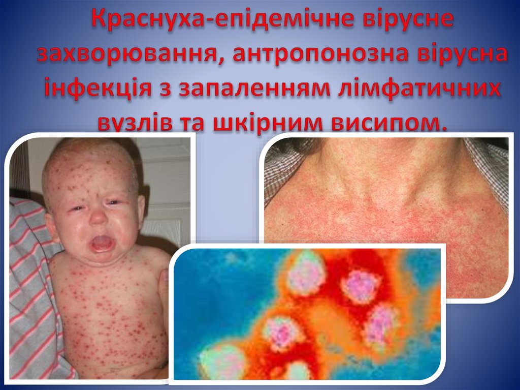Краснуха-епідемічне вірусне захворювання, антропонозна вірусна інфекція з запаленням лімфатичних вузлів та шкірним висипом.