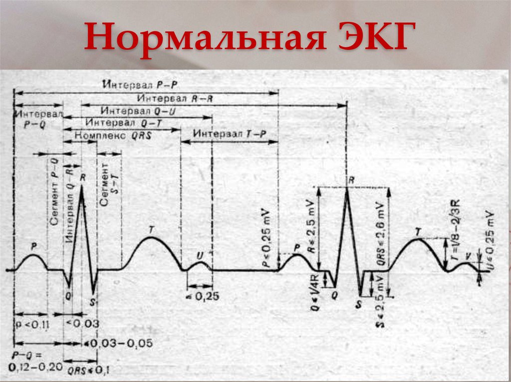 Рисунок нормальной кардиограммы