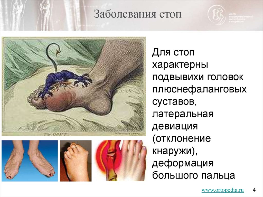 Утренняя скованность суставов стоп Утренняя скованность суставов стоп