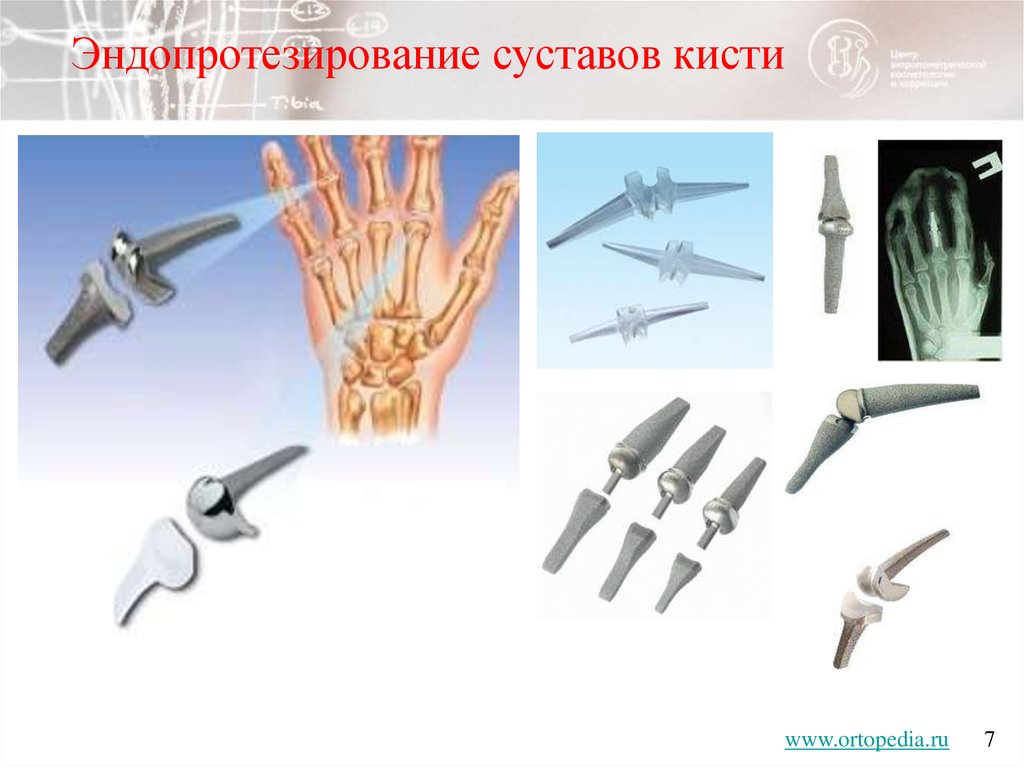 Утренняя скованность суставов кистей Утренняя скованность суставов кистей