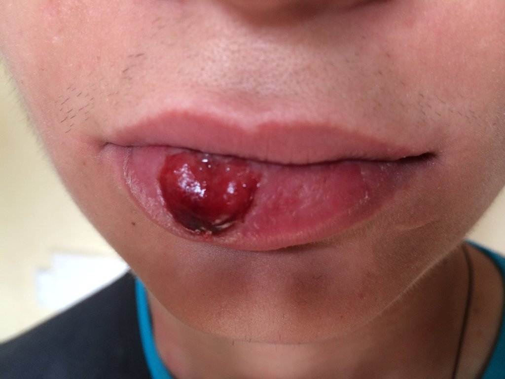 Первичная сифилома на губе