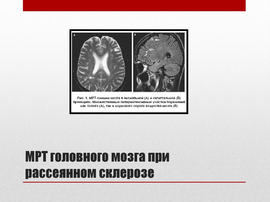 МРТ головного мозга при рассеянном склерозе