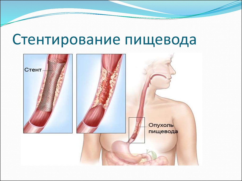 Диета После Операции Пищевода