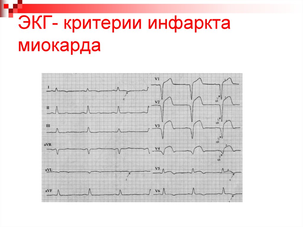 Рисунок кардиограммы сердца при инфаркте миокарда