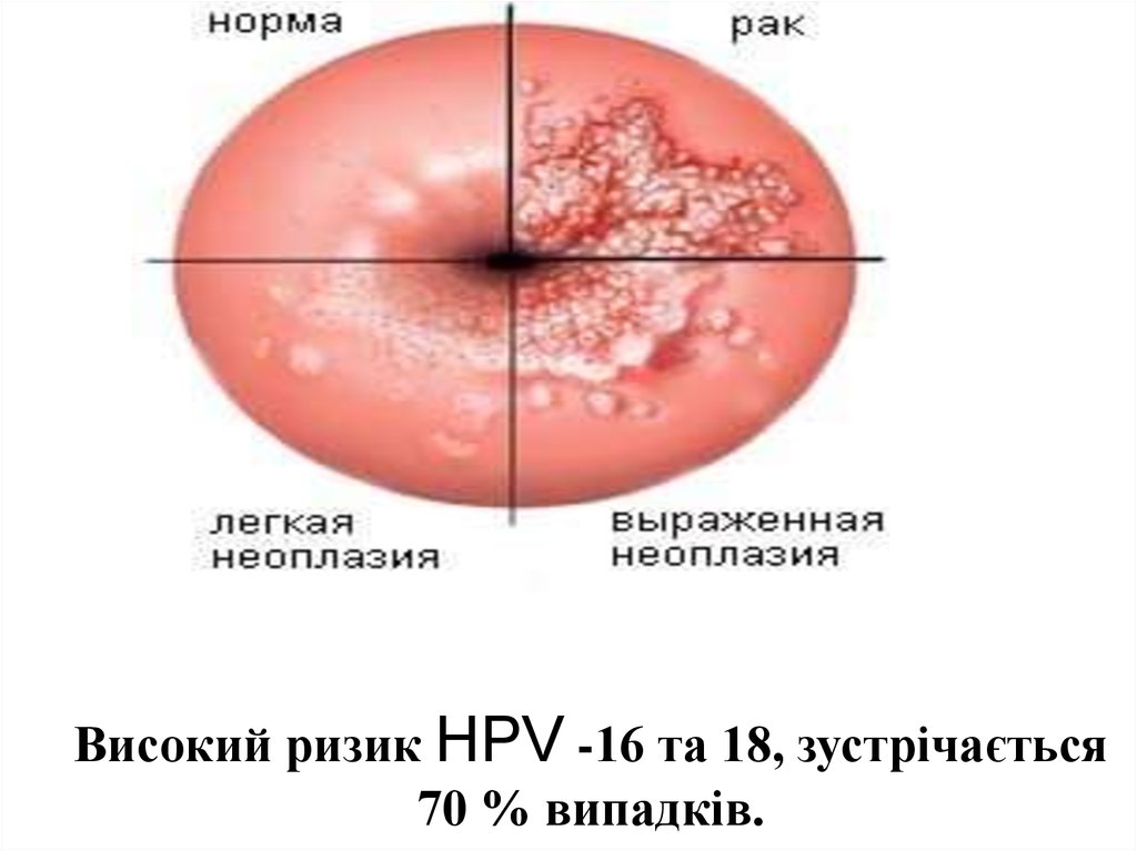 Вирус папилломы человека у женщин гинекология