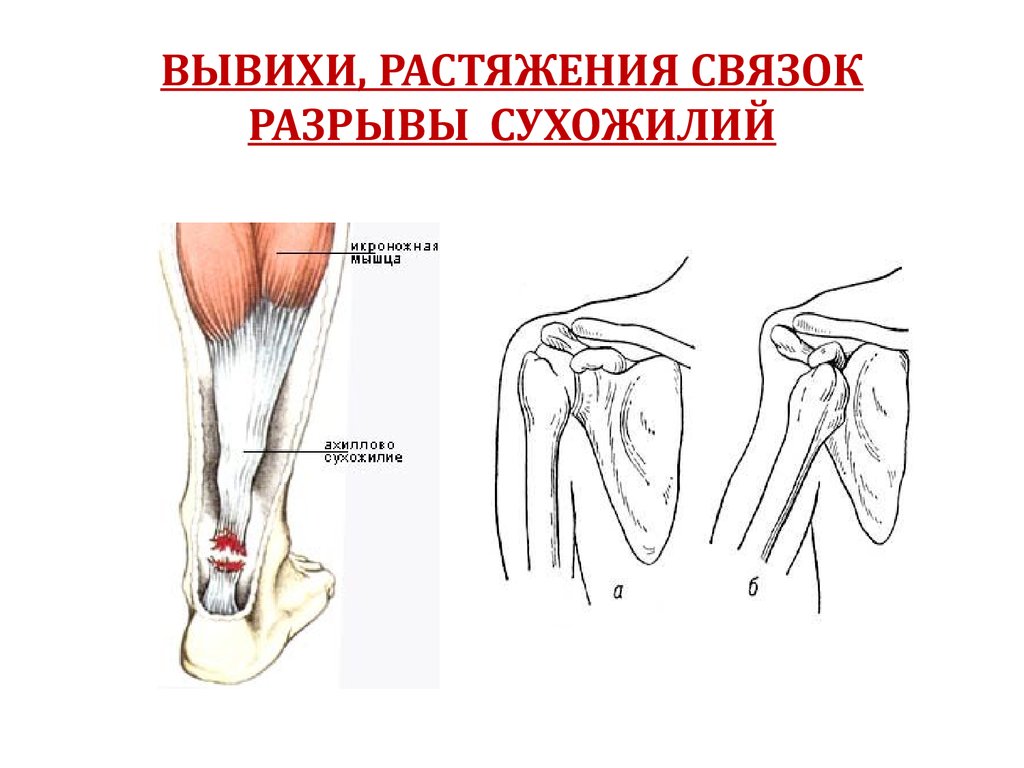 Растяжение связок рисунок