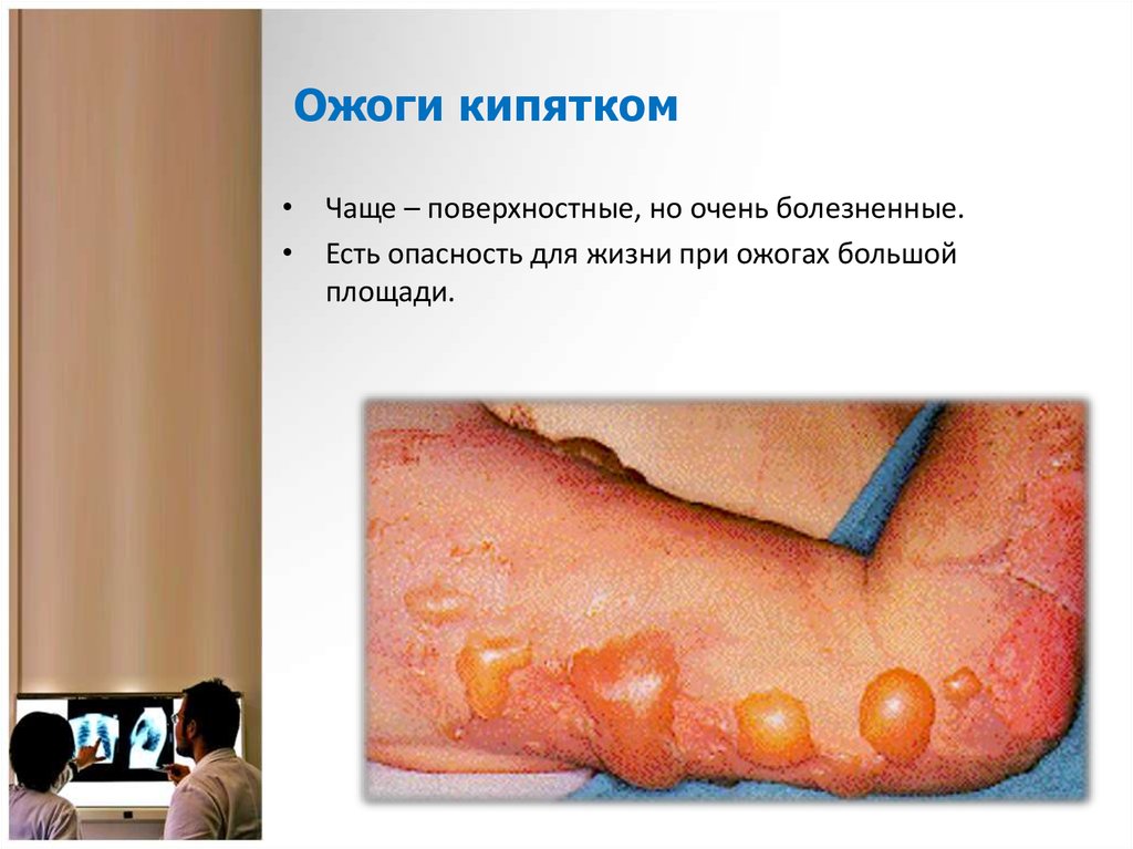 Ожоги кипятком у ребенка лечение в домашних условиях Ожоги кипятком у ребенка лечение в домашних условиях