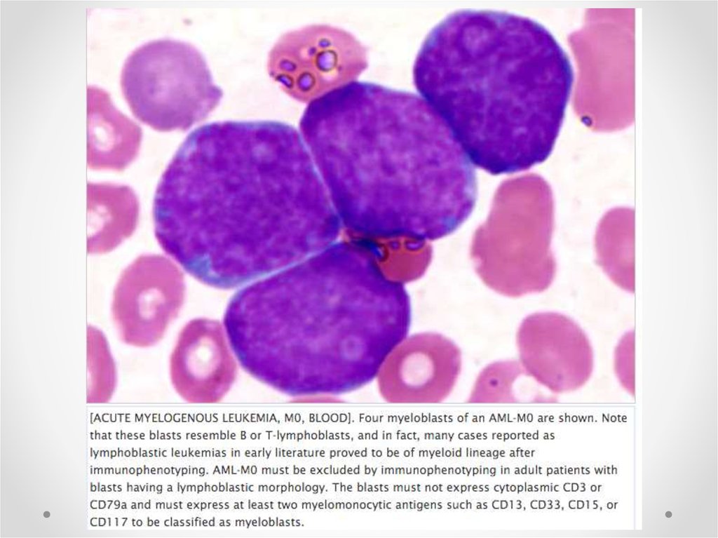 what is acute myeloid leukemia