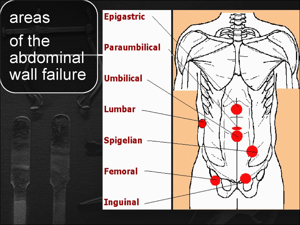 Types Of Abdominal Wall Hernias Images And Photos Finder