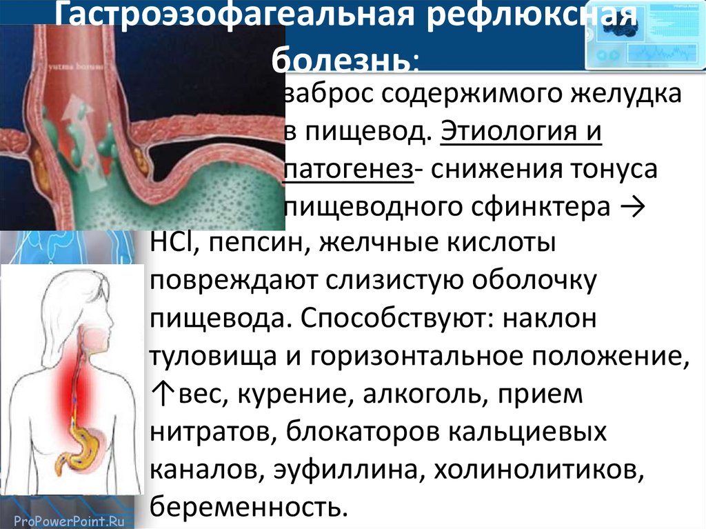 Диета При Гастроэзофагеальной Рефлюксной Болезни С Эзофагитом