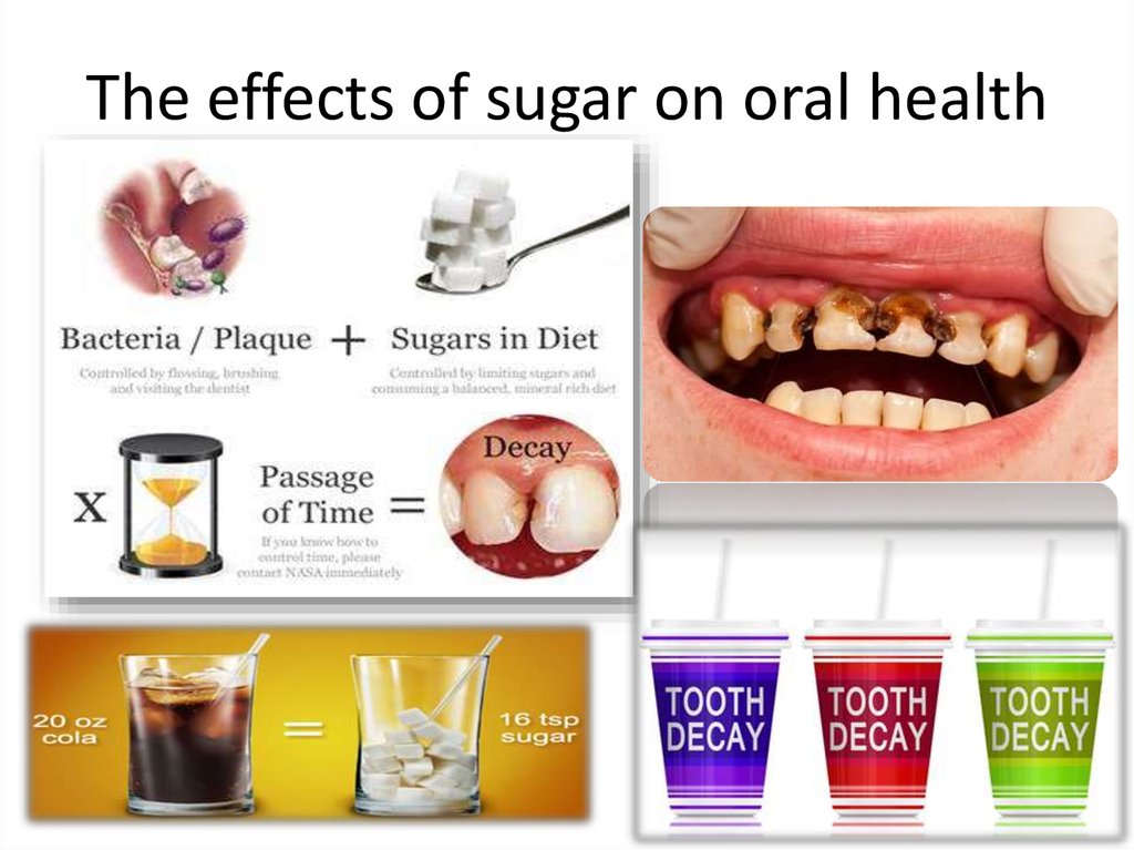 How Does Sugar Affect Your Teeth