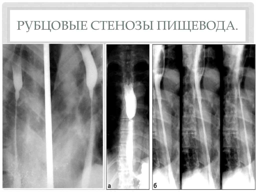 Диета При Стенозе Пищевода