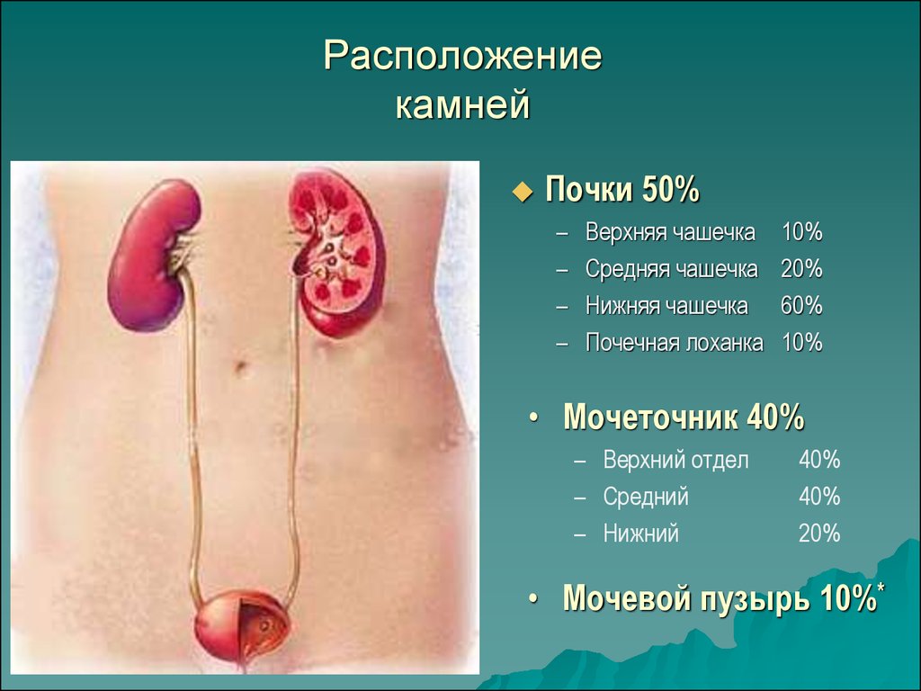 Камни в почках презентация