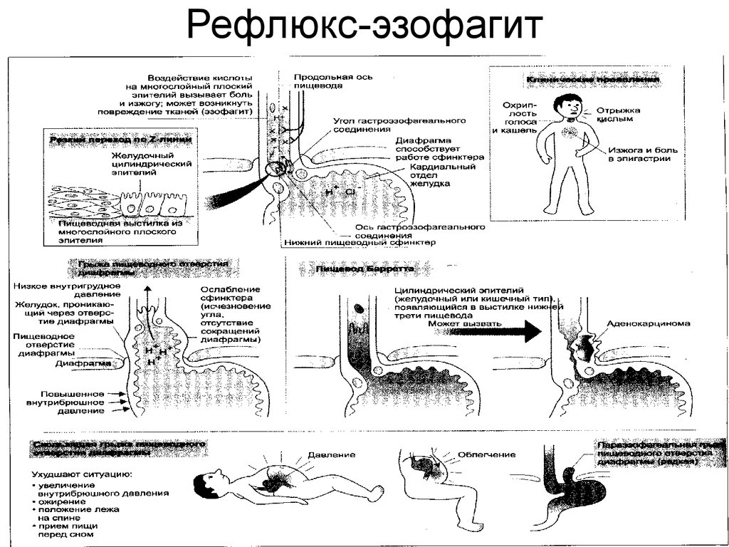 Диета При Рефлюксе Эзофагите Лечение