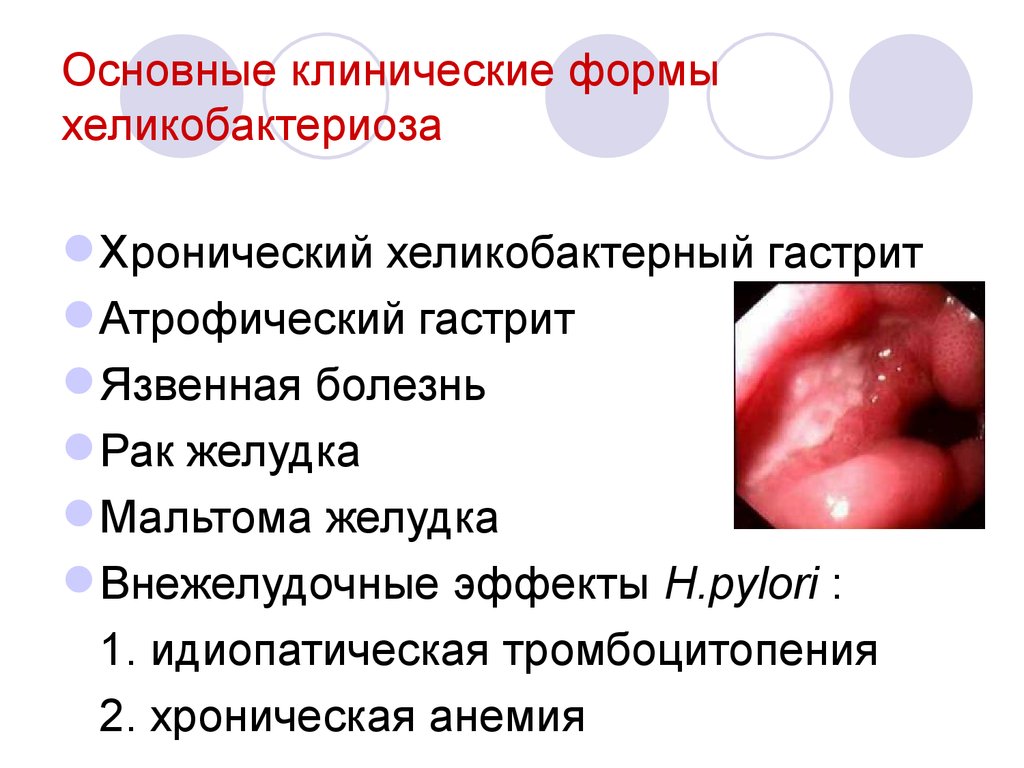 Основные клинические формы хеликобактериоза
