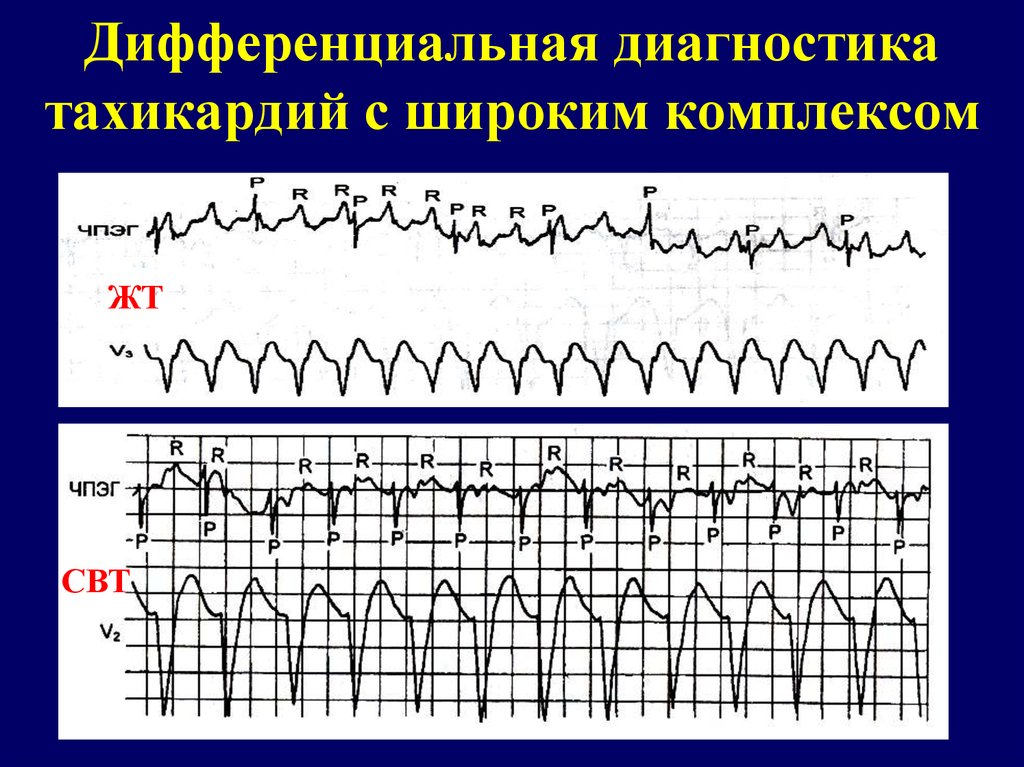 Лишний Вес Тахикардия