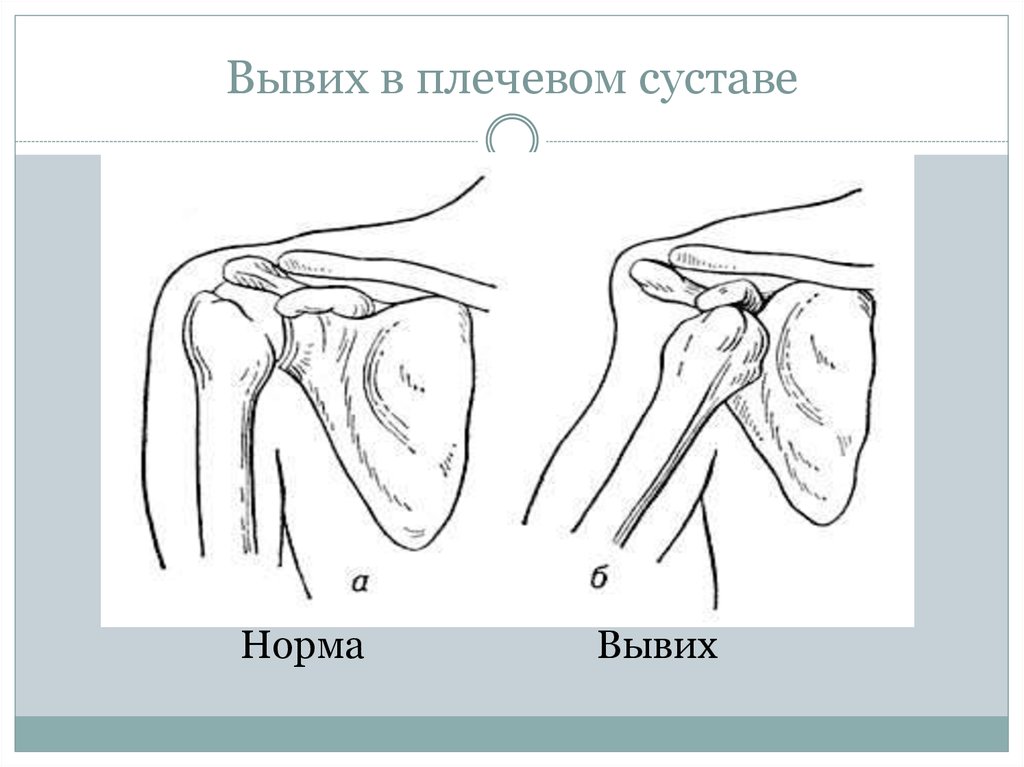 Вывих и подвывих схема