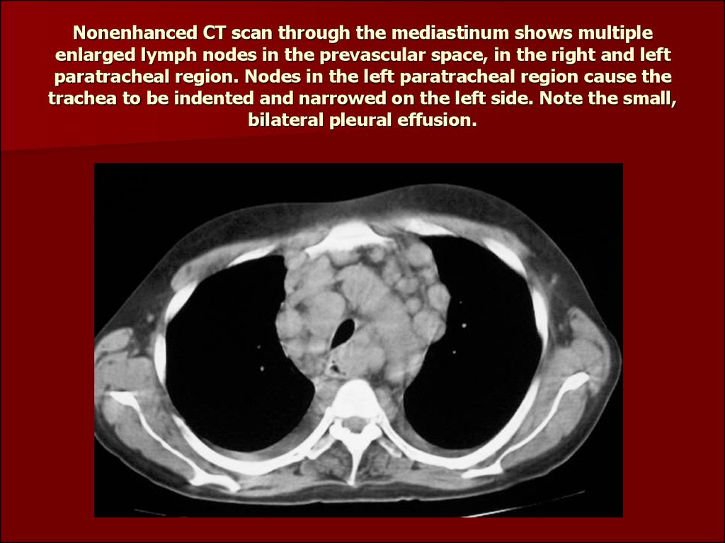 shotty mediastinal lymph nodes