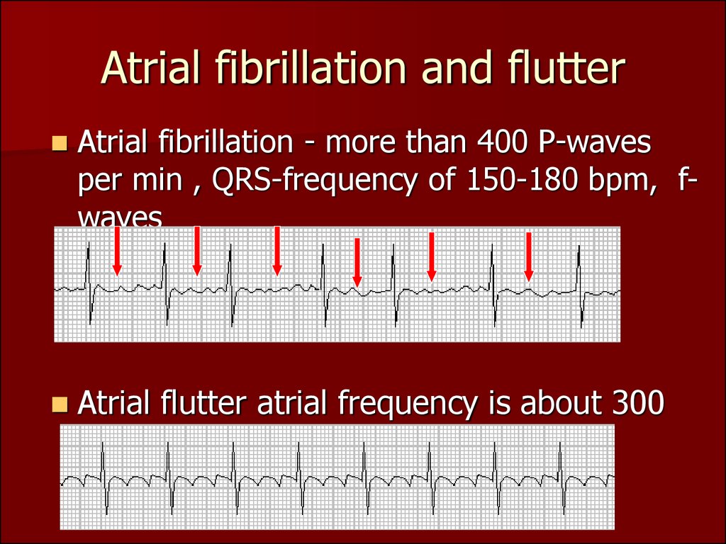 atrial fibrillation vs flutter