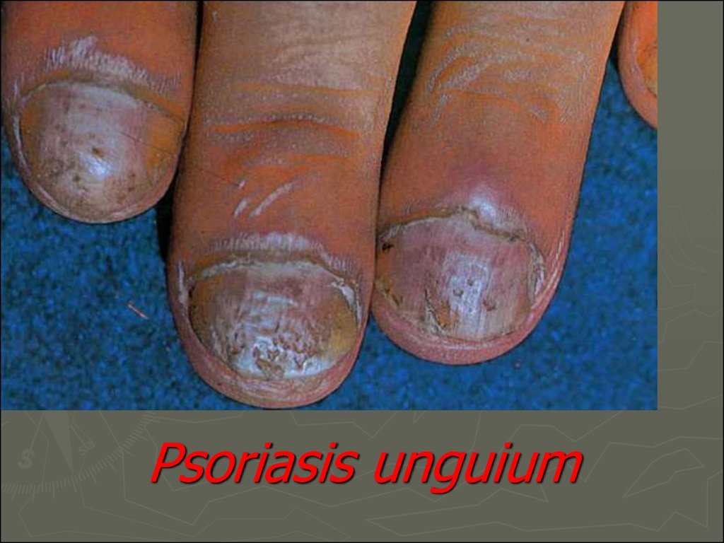 Psoriasis. Classification of psoriasis - презентация онлайн1024 x 768
