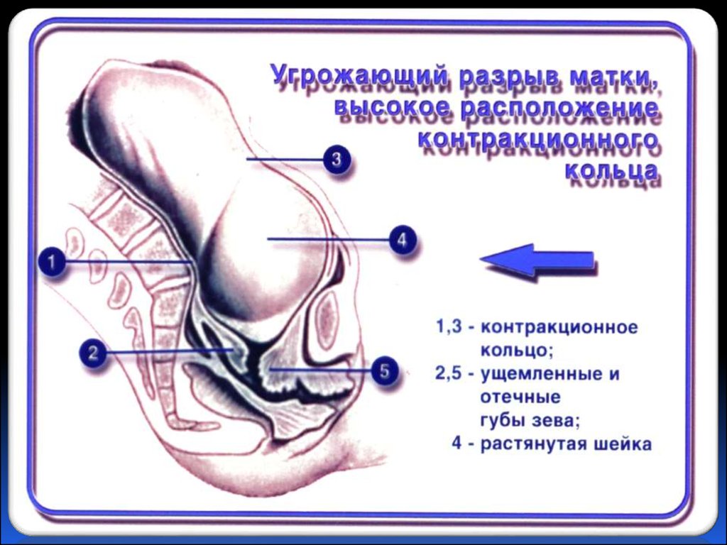 презентация родовой травматизм