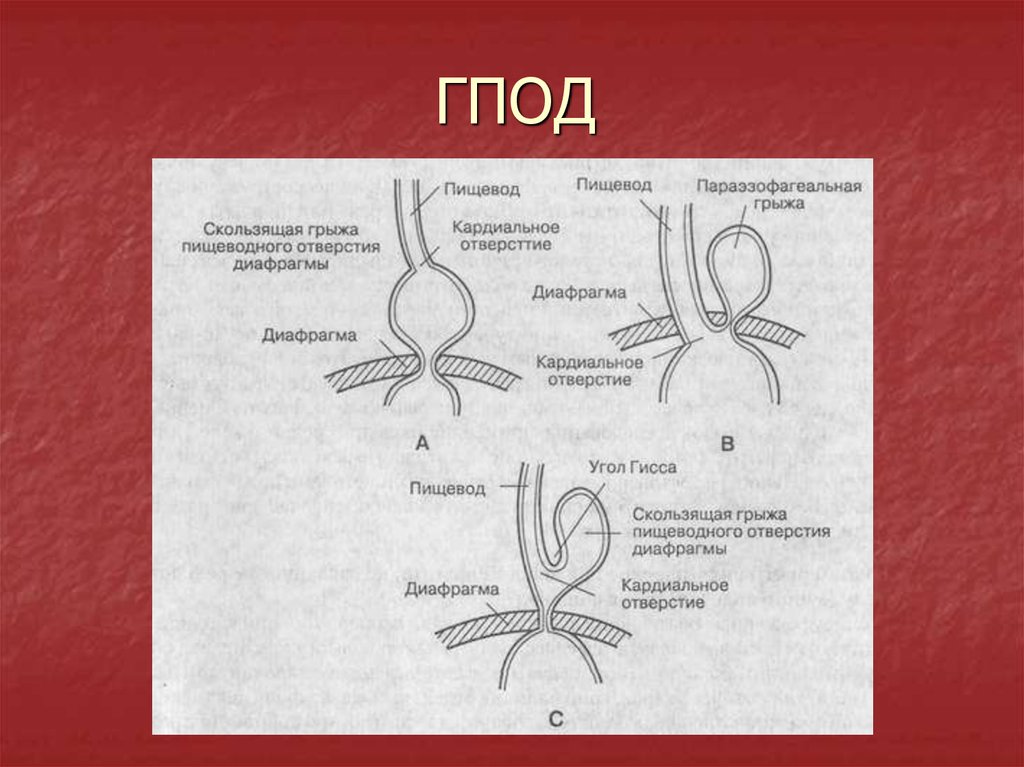 Диета При Кардиальной Грыжи Пищевода Не Фиксированной