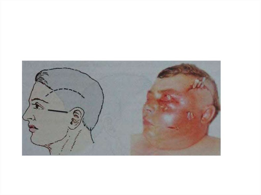 Флегмона шеи