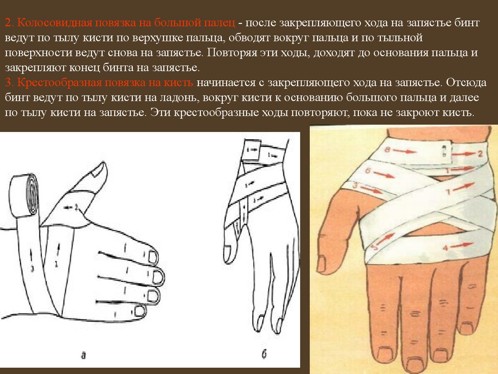2. Колосовидная повязка на большой палец - после закрепляющего хода на запястье бинт ведут по тылу кисти по верхушке пальца, обводят вокруг 