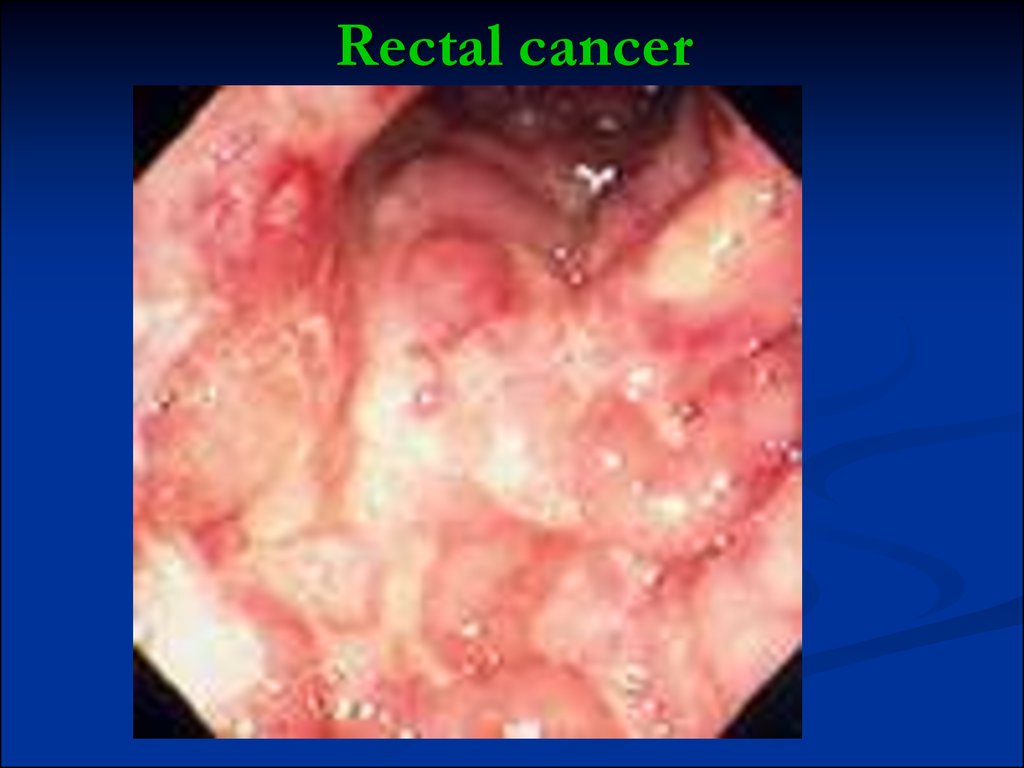 and cancer Rectal anal