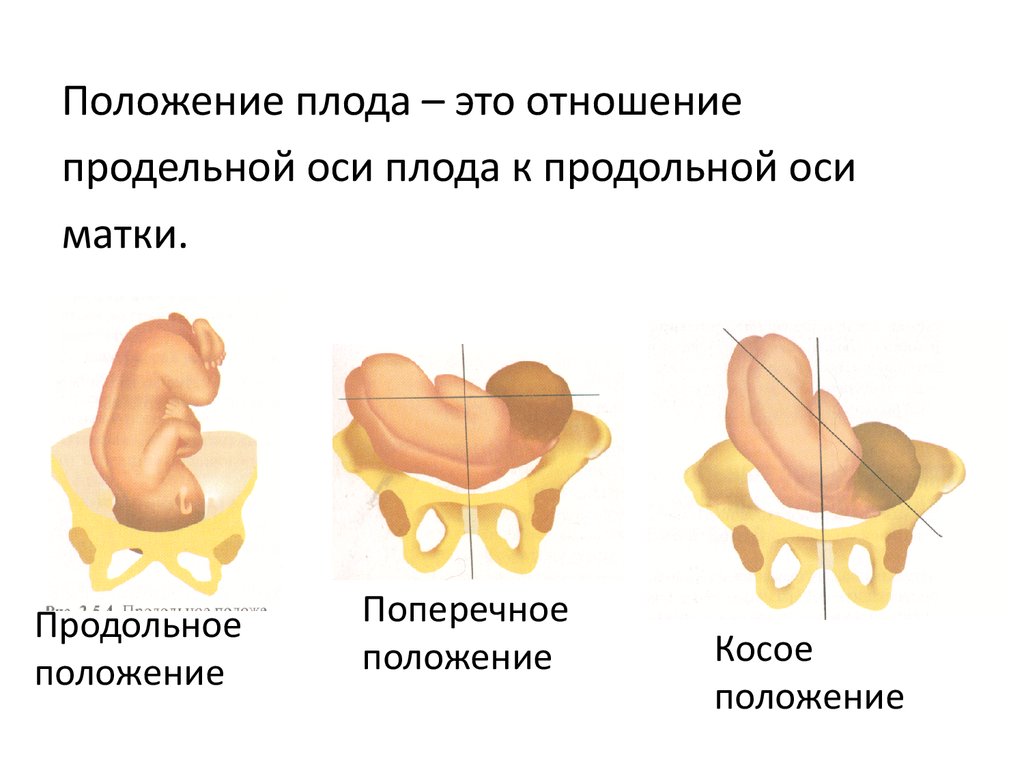 Положение плода продольное головное предлежание это как фото