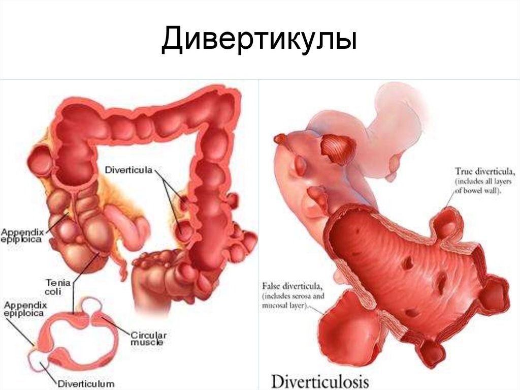 Дивертикулит Сигмовидной Кишки Питание Диета После Операции