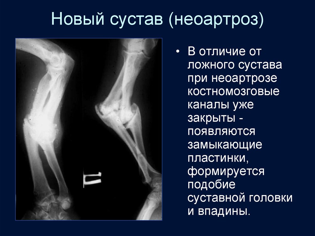 Ложный сустав презентация