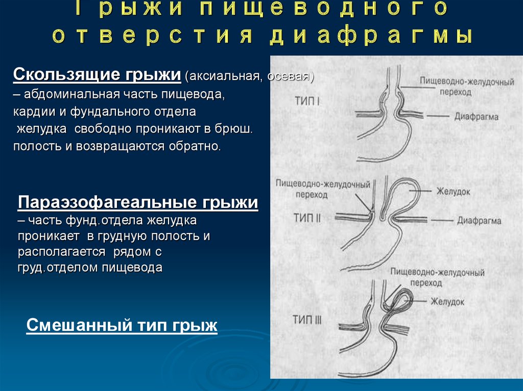 Операция Грыжа Пищевода Диета