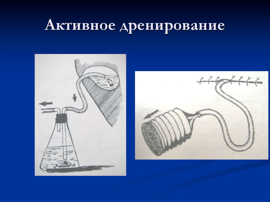 Картинки дренирование раны