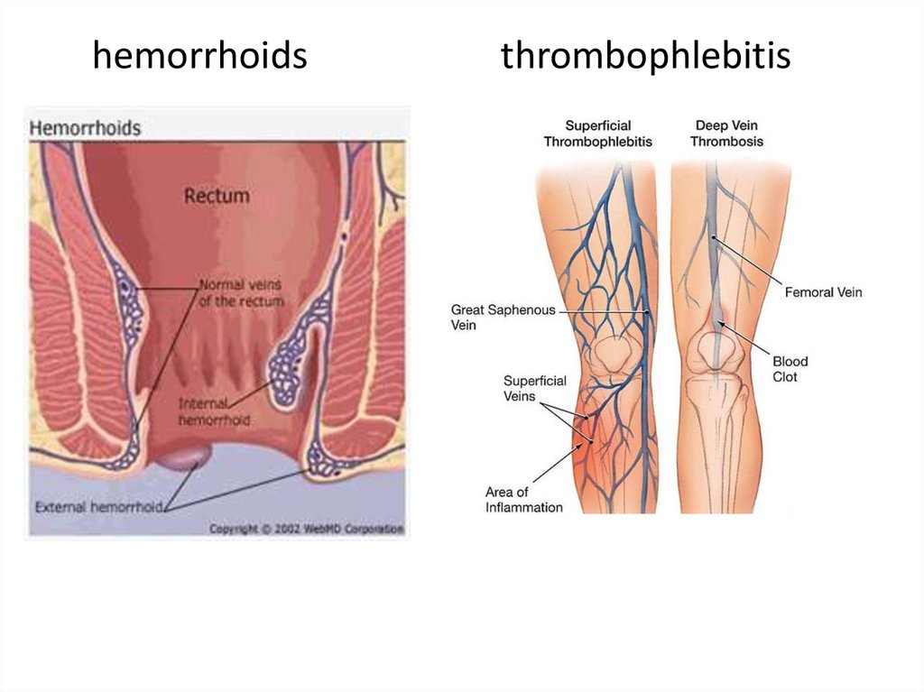 Deep vein thrombosis penis